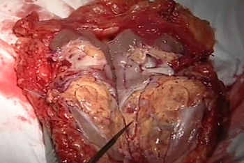 Опухоль почки